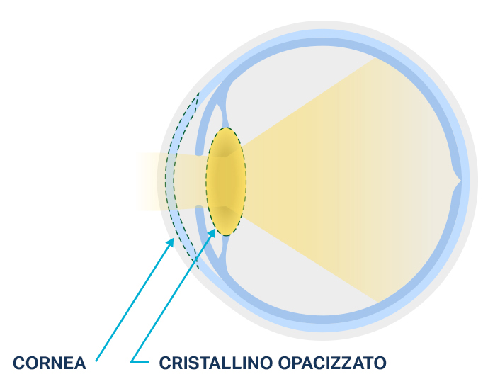 Diagramma di un cristallino normale rispetto a un cristallino opacizzato da una cataratta oculare